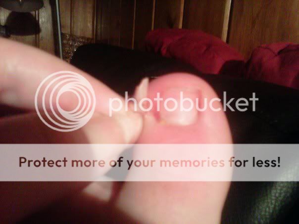 bed killed soon because im tired of the ingrown toenail i had it removed bed killed soon because im tired of the ingrown toenail i had it removed